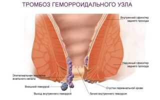 Тромбоз наружного геморроидального узла: симптомы и лечение
