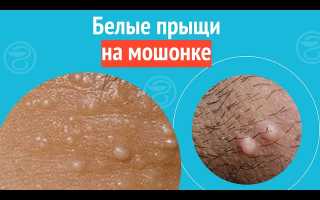 Причины появления белых прыщей на яйцах у мужчин и их лечение
