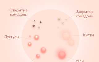Какие бывают виды прыщей?