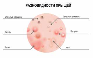 Как проявляются и лечатся простудные прыщи?