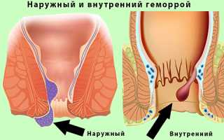 Что делать, если лопнул геморрой, как остановить кровь?