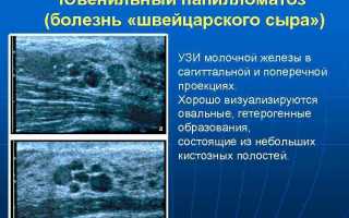 Лечение внутрипротоковой папилломы молочной железы.