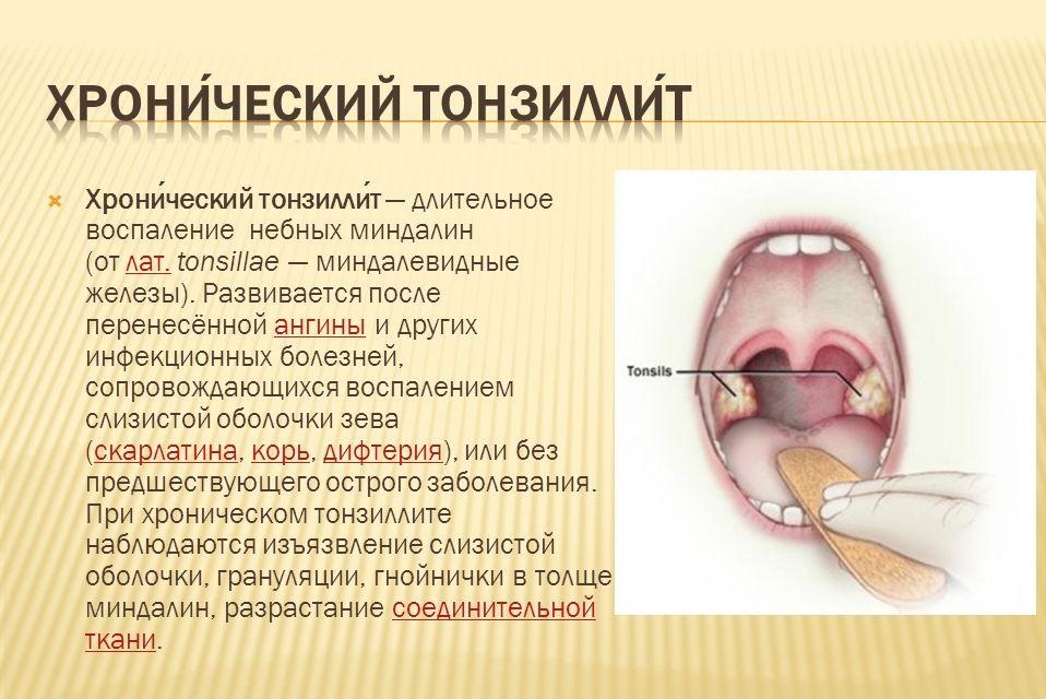 Хронический тонзиллит Хронический тонзиллит