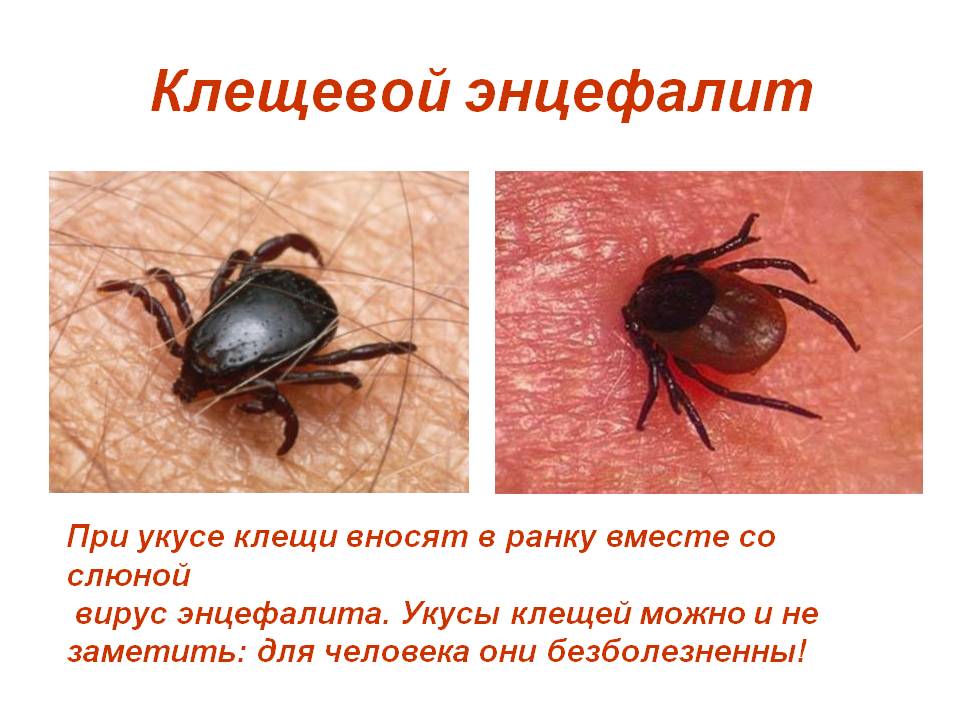 Клещевой энцефалит