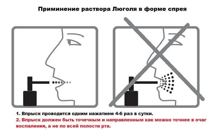 Применение раствора Люголя в форме аэрозоля