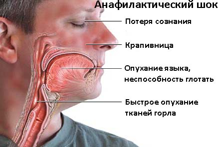 Симптомы анафилактического шока