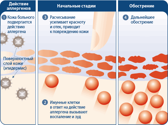 Схема образования аллергического дерматита Схема образования аллергического дерматита