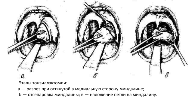 Этапы тонзиллэктомии Этапы тонзиллэктомии