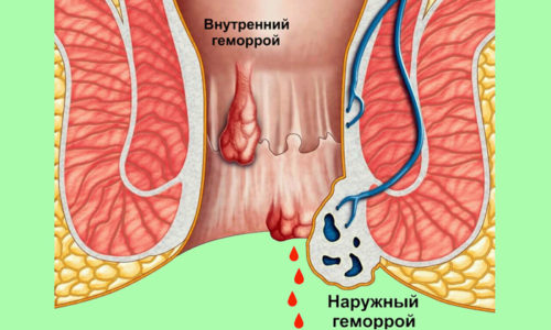 Из-за вброса адреналина в организм происходит повышение активности тромбоцитов, что в свою очередь, позволяет остановить кровотечение