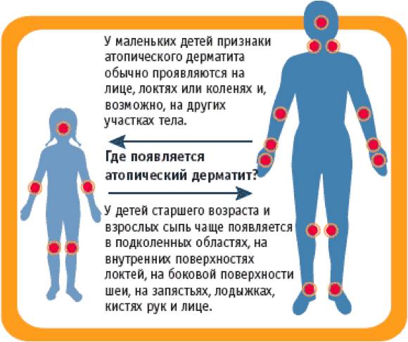 Места проявления дерматита