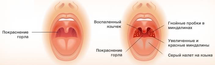 Признаки ангины Признаки ангины