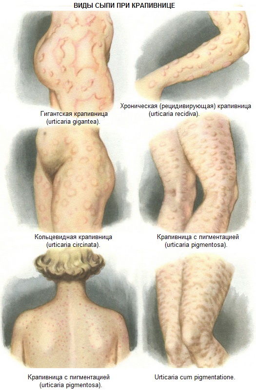 Виды сыпи при крапивнице