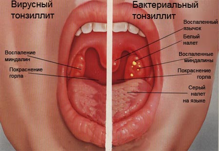 Виды тонзиллита