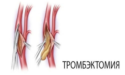Нарушение оттока венозной крови провоцирует образование тромба внутри выпавшего узла. Для удаления тромба используется метод тромбэктомии