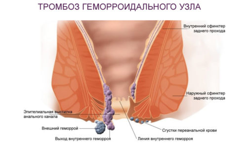 Тромбоз наружного геморроидального узла является распространенным осложнением геморроя