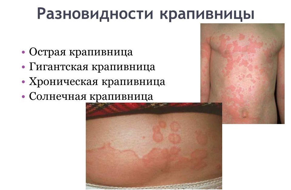Крапивница при поллинозе