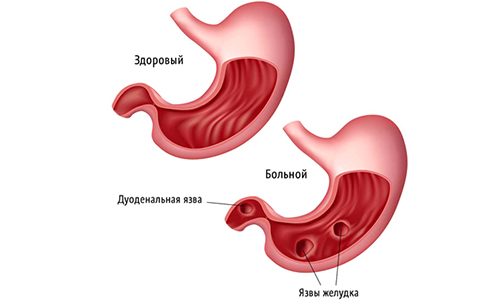 Сок не рекомендуется пить при заболеваниях ЖКТ, таких как язва